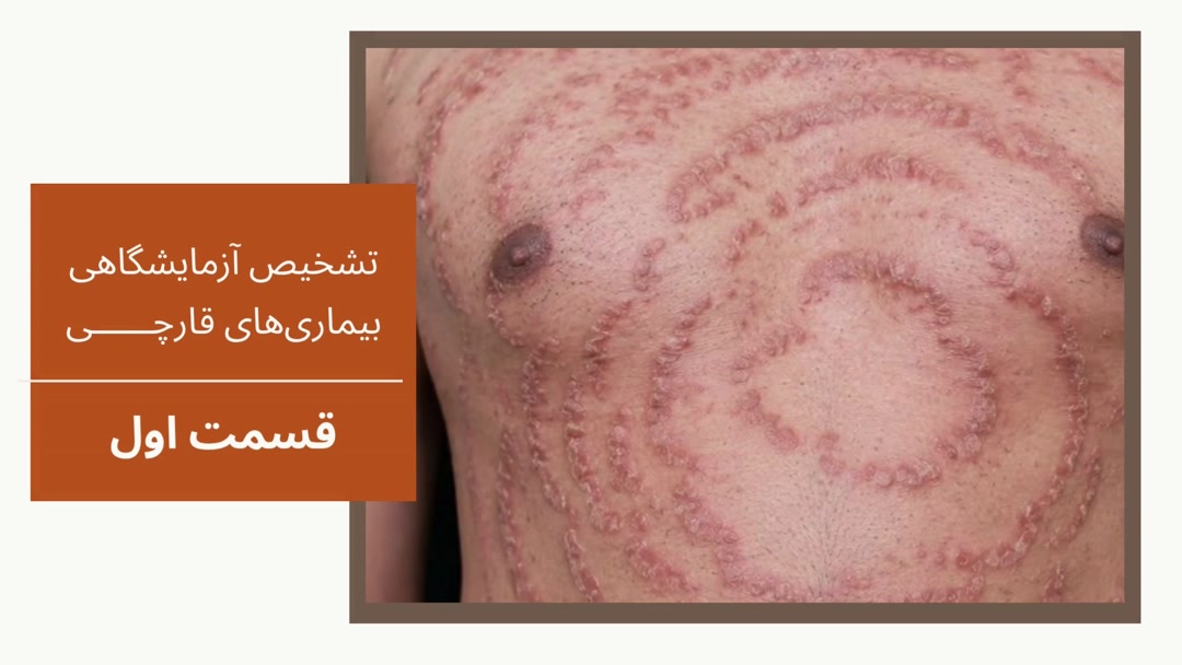روش نمونه برداری از ضایعات مشکوک به تینا کورپوریس یا کچلی بدن